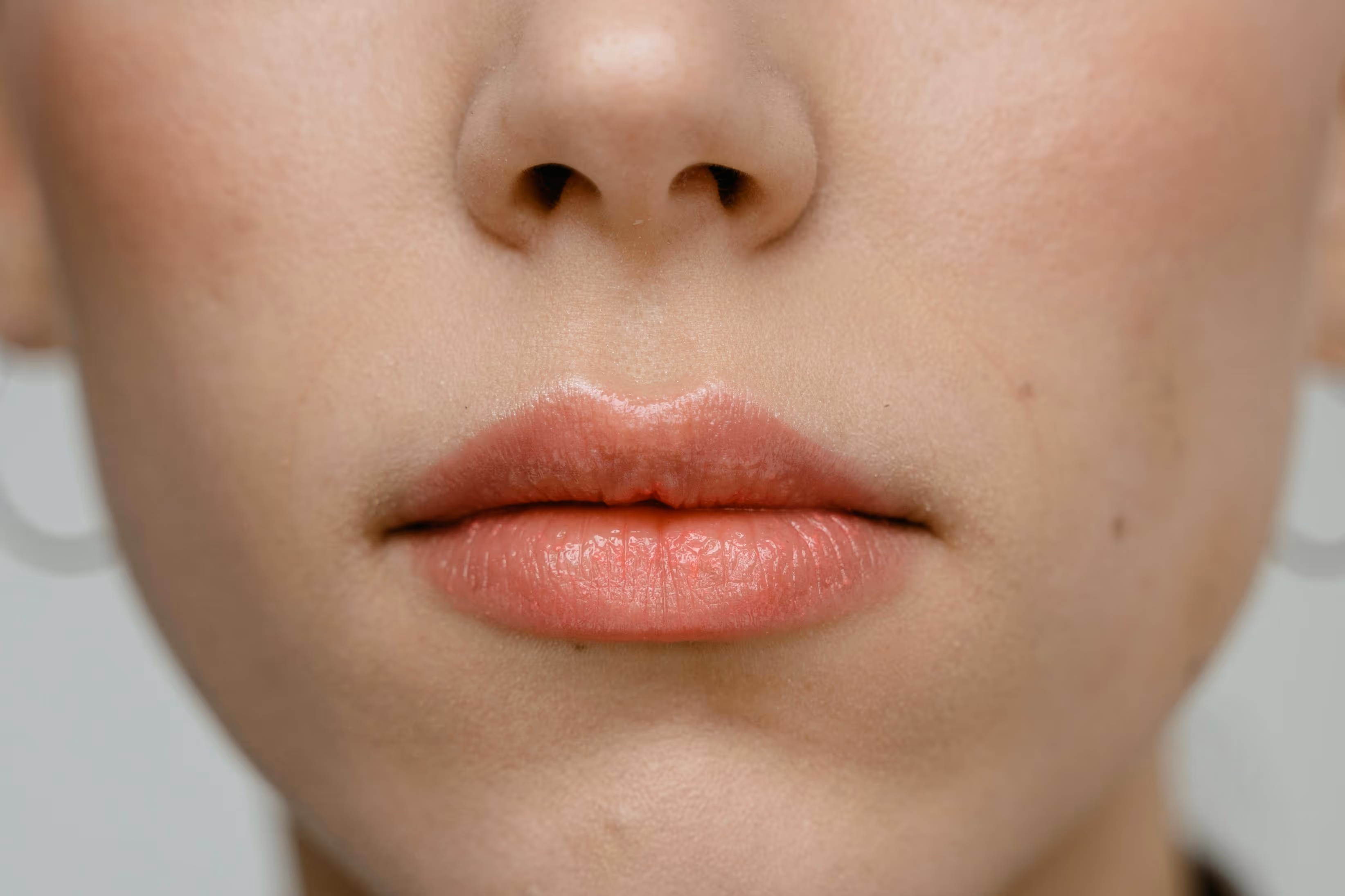Lip Fillers